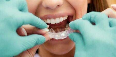 all about clear aligner process