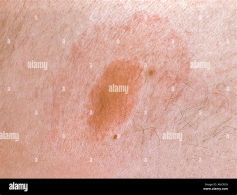 Target Rash from Deer Tick Bite Transmitting Lyme s Disease Stock Photo ...