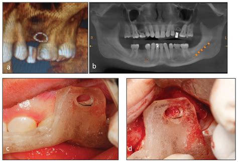 Implant Therapy of Non-Syndromic Severe Oligodontia: A Clinical Report