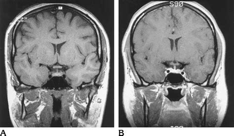 Figure 1 from Measurement of the normal optic chiasm on coronal MR ...