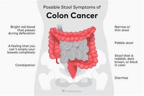 Colon Cancer Stool Signs and Symptoms