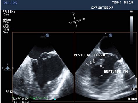 Transesophageal echocardiography findings. Partial papillary muscle... | Download Scientific Diagram