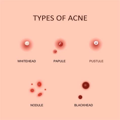 Pimple Illustrations, Royalty-Free Vector Graphics & Clip Art - iStock