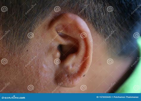 Close-up Image of a Man& X27;s Ear, Ear Infection, Ear Pain, Medical ...