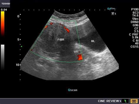 cochinblogs: Subserosal fibroid