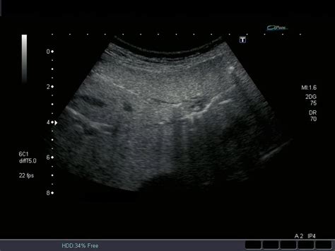 Biliary tree pathology – ULTRASOUNDPAEDIA