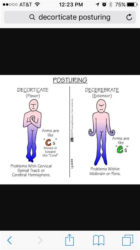 Decorticate vs. Decerebrate Posturing | Respiratory therapy notes ...