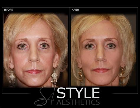 Liquid-Facelift-Face-Lift-Before-After-Photos-Portland-Oregon-0417 ...