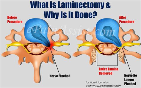 Laminectomy Syndrome