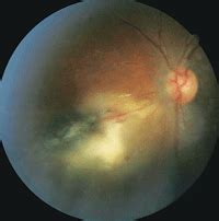 The Many Faces of Ocular Toxoplasmosis