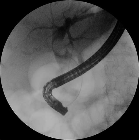 Contrast cholangiography revealing macrolithiasis of CBD in patient... | Download Scientific Diagram