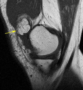 Lipoma Arborescens Knee