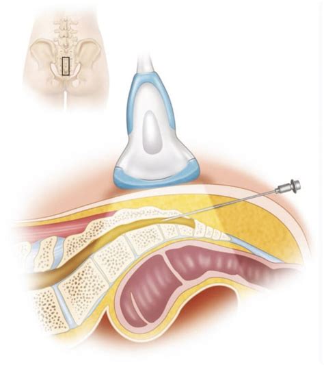 Ultrasound-Guided Caudal Epidural Injections - NYSORA