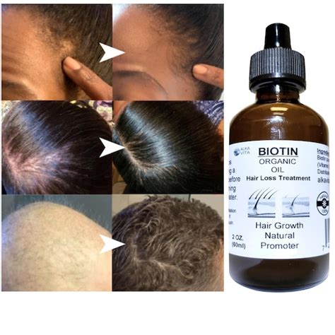 Biotin Hair Loss Growth Promoter Organic Oil & Silica Infused - Etsy