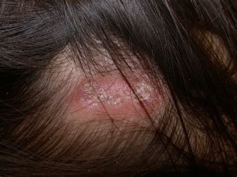 Discoid Lupus Erythematosus | Treatment & Management | Point of Care