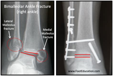 Ankle Fracture ORIF - FootEducation