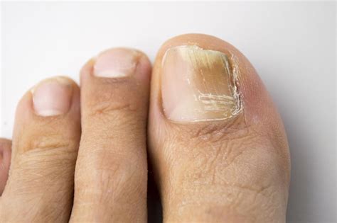 Fungal nail problems - myDr.com.au