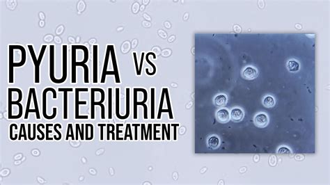 Pyuria Vs. Bacteriuria Causes and Treatment