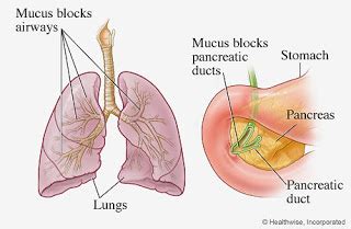 How the Chloride Sweat Test in Cystic Fibrosis Works - Renal Fellow Network