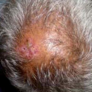 (PDF) Discoid lupus erythematosus: A case report with review of the literature