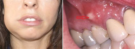 dental abscess infection, Tooth Abscess infection, Gum Abscess ...