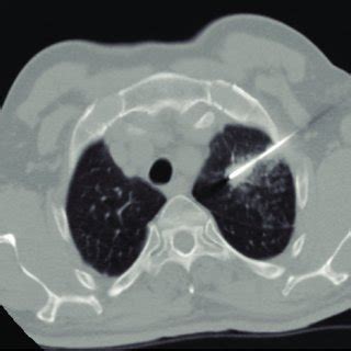 CT-guided lung biopsy of left sided 16 mm pulmonary nodule and... | Download Scientific Diagram