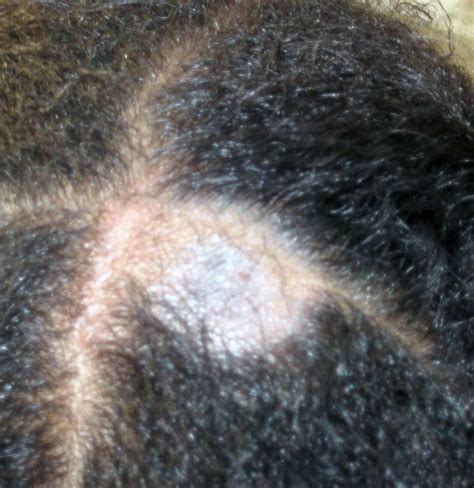 Tinea Capitis (scalp Ringworm): Causes, Symptoms, And