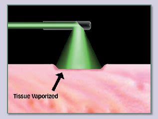 Greenlight Laser Photovaporization Of The Prostate Cpt Code ...