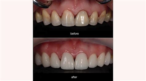 Composite Veneers: The Ultimate Guide | Cost, Procedure, Benefits