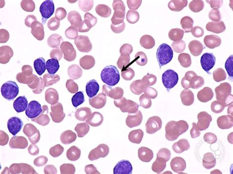 Chronic Lymphocytic Leukemia - 3.