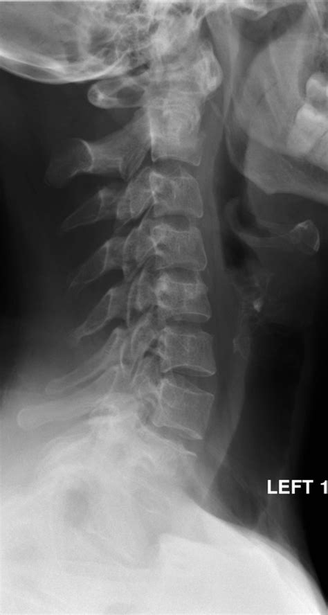 Interpreting cervical spine radiographs | The BMJ