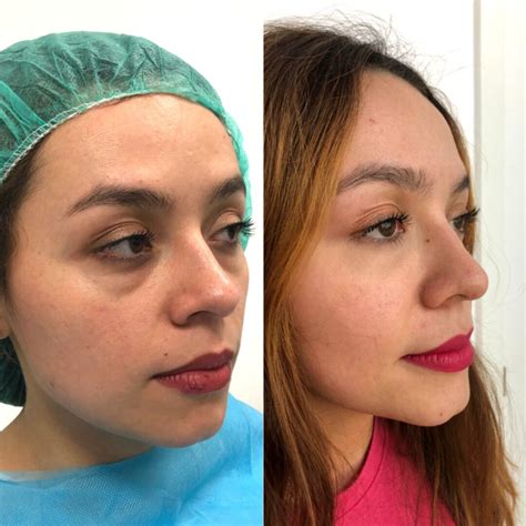 Lo hemos probado: relleno de ojeras con ácido hialurónico - Multiestetica.com