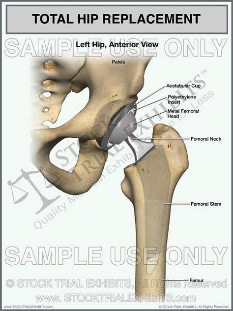 Pin by Stock Trial Exhibits on Medical Illustrations for Legal Cases | Total hip replacement ...