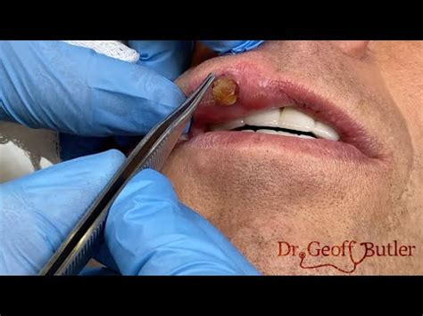 Removal of a pyogenic granuloma on the lip - YouTube