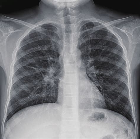 Chest X-ray demonstrating diffuse, bilateral bronchiectasis. | Download ...