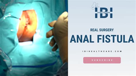 Anal Fistula Surgery