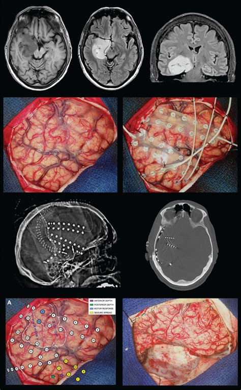 Pathogenesis and Management of Brain Tumor-Related Epilepsy - Gliomas ...