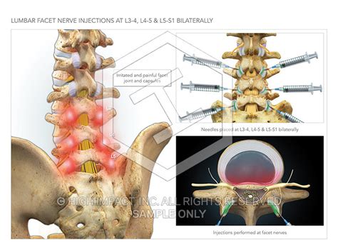 Image 09765_im04: Lumbar Facet Nerve Injections at L3-4, L4-5, L5-S1 B