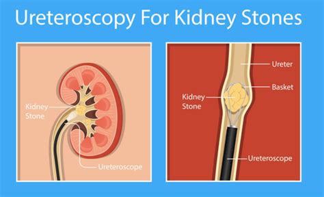 What To Expect When You Need A Kidney Stone Surgery | Medanta