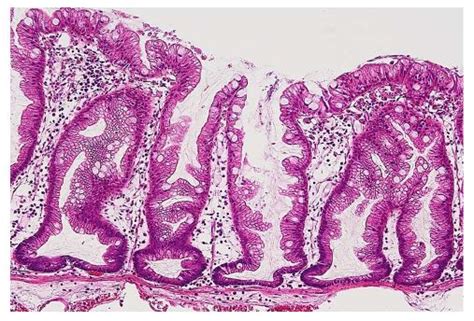 Adenomatous Polyp Histology