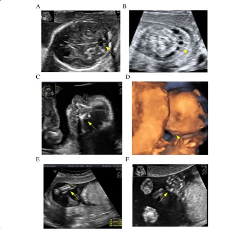 Abnormal foetal image in ultrasound examination at 18 weeks of ...