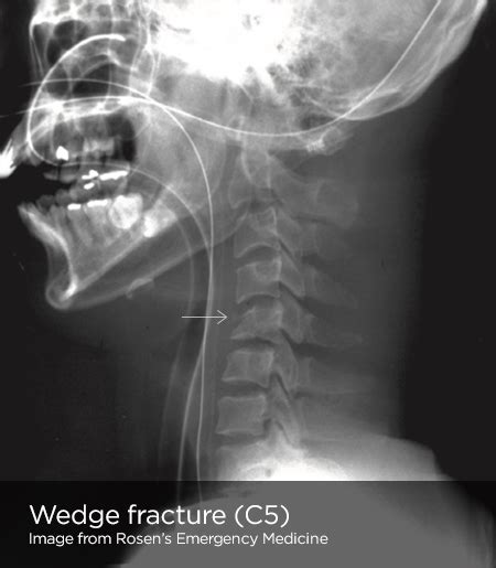 What Is The Icd 10 Code For Osteomyelits Cervical Spine