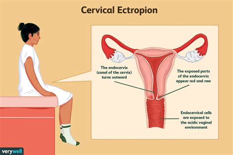 Cervical Ectropion: Symptoms, Causes, and Treatment