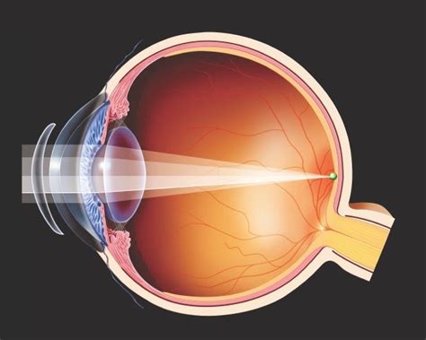 crystalline lens - Google Search | Presbyopia, Multifocal, Lens