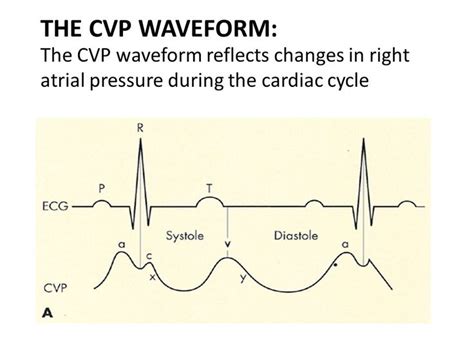 the vcp waveform reflects changes in right atrial pressure during the cardiac cycle