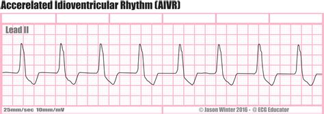 ECG Educator Blog : Accelerated Idioventricular Rhythm (AIVR)