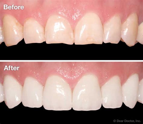 Porcelain Veneers | Family and Children’s Dentistry | Atlanta Georgia