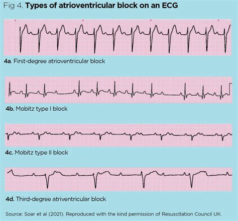 Different Types Of Abnormal Ekg