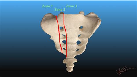 Denis Classification of Sacral Fractures | UW Emergency Radiology