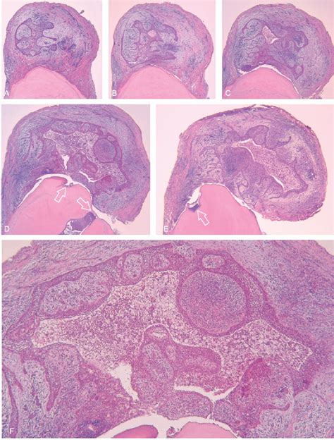 [PDF] Histologic features of apical periodontitis in human biopsies | Semantic Scholar